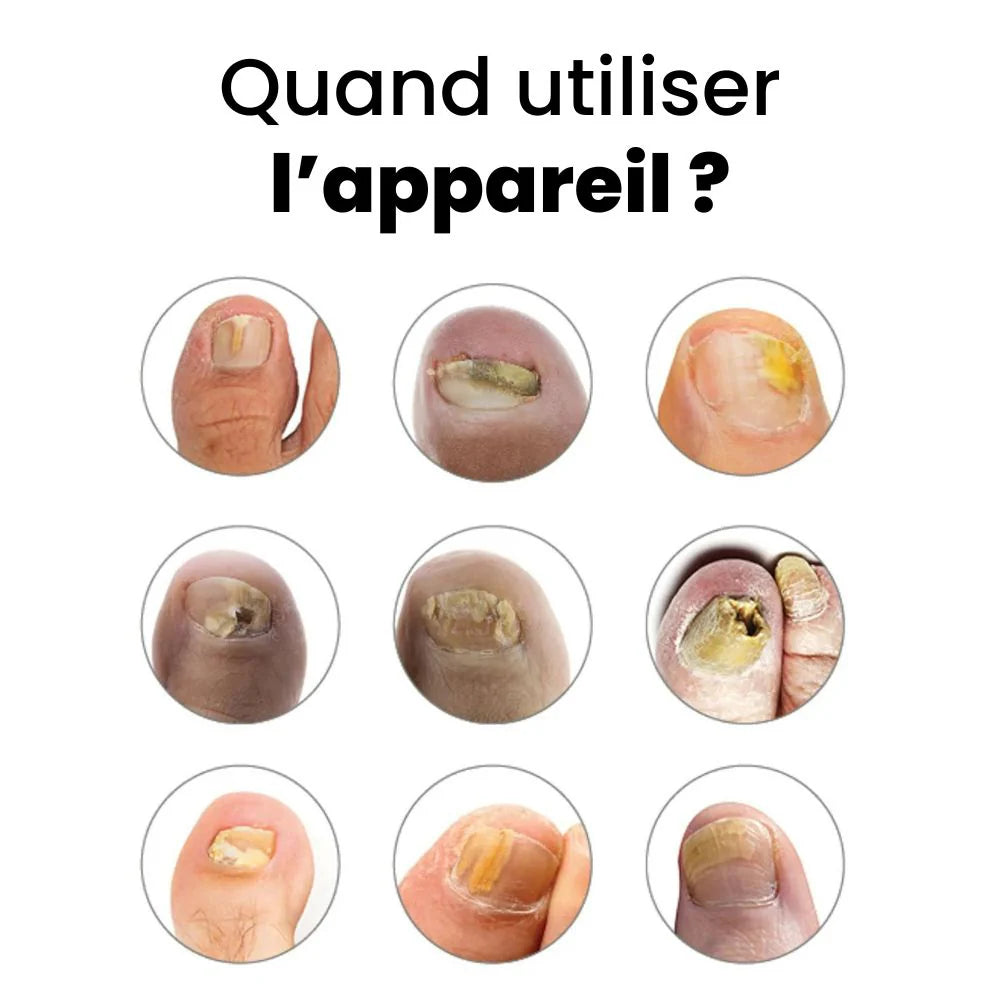 DITES ADIEU AU MYCOSES DES ONGLES