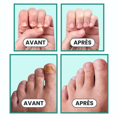 DITES ADIEU AU MYCOSES DES ONGLES